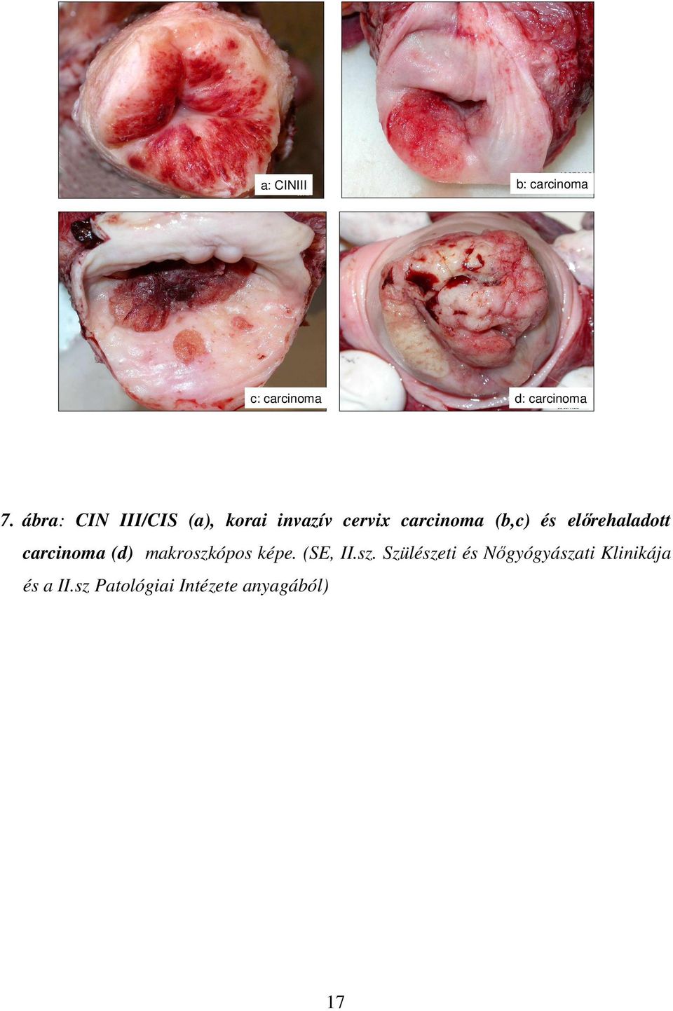 elırehaladott carcinoma (d) makroszk