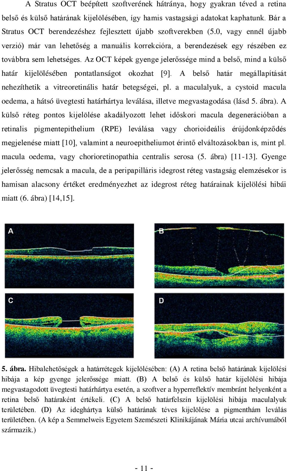 Az OCT képek gyenge jelerőssége mind a belső, mind a külső határ kijelölésében pontatlanságot okozhat [9]. A belső határ megállapítását nehezíthetik a vitreoretinális határ betegségei, pl.
