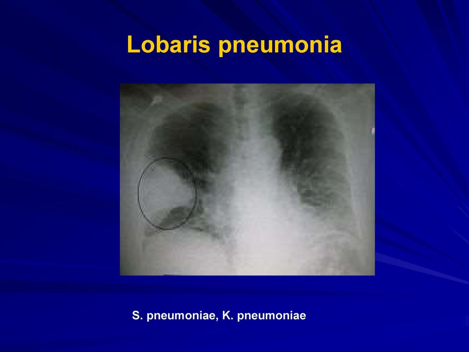 pneumoniae,