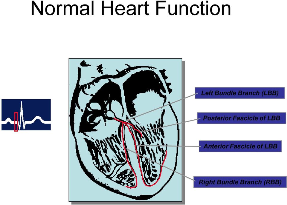 Fascicle of LBB Anterior