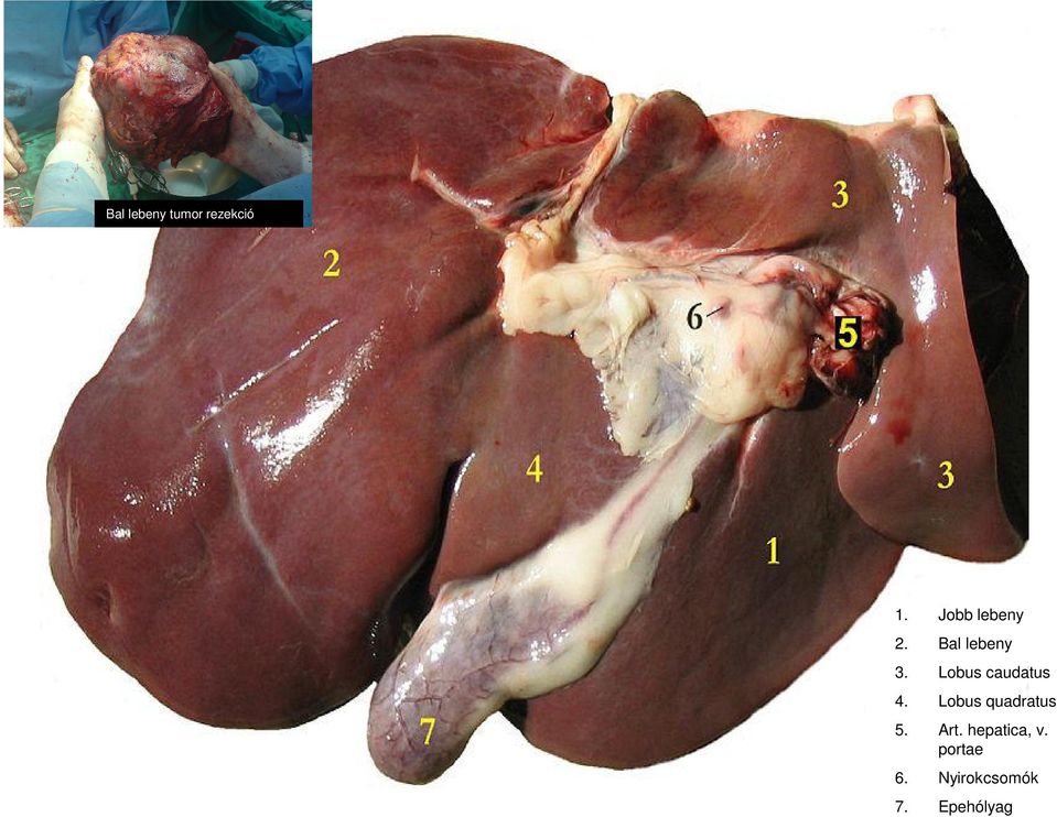 Lobus caudatus 4. Lobus quadratus 5.