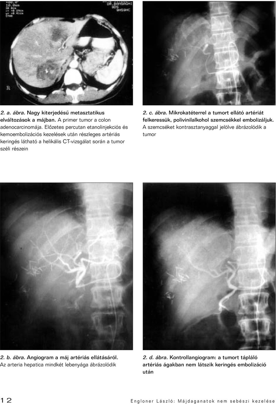 Mikrokatéterrel a tumort ellátó artériát felkeressük, polivinilalkohol szemcsékkel embolizáljuk. A szemcséket kontrasztanyaggal jelölve ábrázolódik a tumor 2. b. ábra.