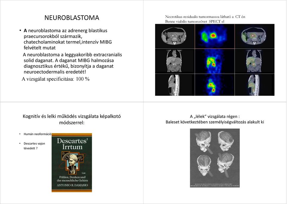 A daganat MIBG halmozása diagnosztikus értékű, bizonyítja a daganat neuroectodermalis eredetét!