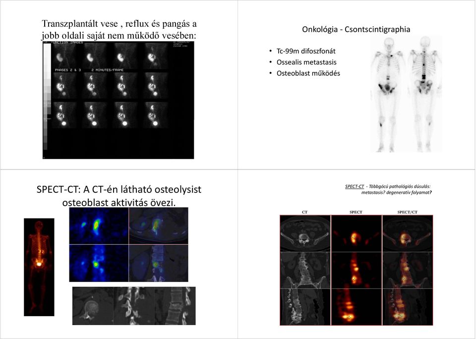 működés SPECT CT: A CT én látható osteolysist osteoblast aktivitás övezi.