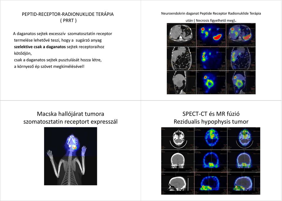 A daganatos sejtek excesszív szomatosztatín receptor termelése lehetővé teszi, hogy a sugárzó anyag szelektive csak a