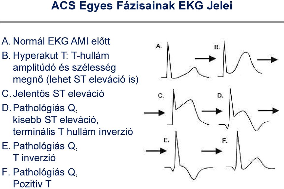 eleváció is) C. Jelentős ST eleváció D.