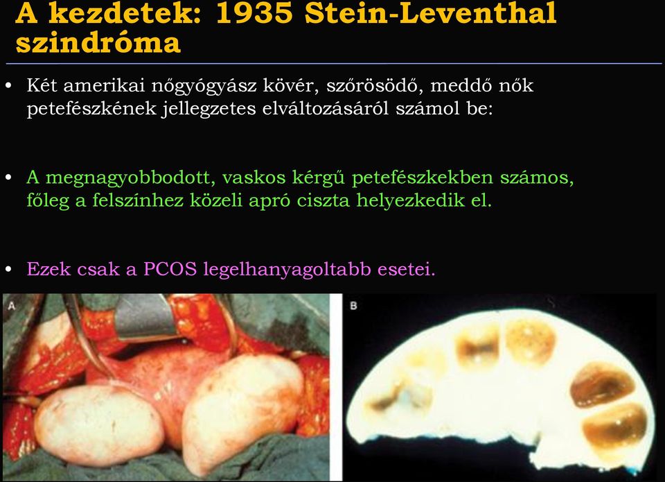 megnagyobbodott, vaskos kérgű petefészkekben számos, főleg a felszínhez