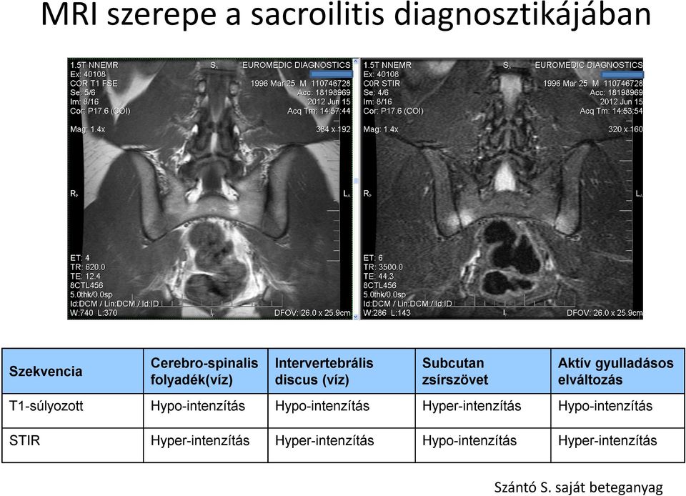 T1-súlyozott Hypo-intenzítás Hypo-intenzítás Hyper-intenzítás Hypo-intenzítás STIR