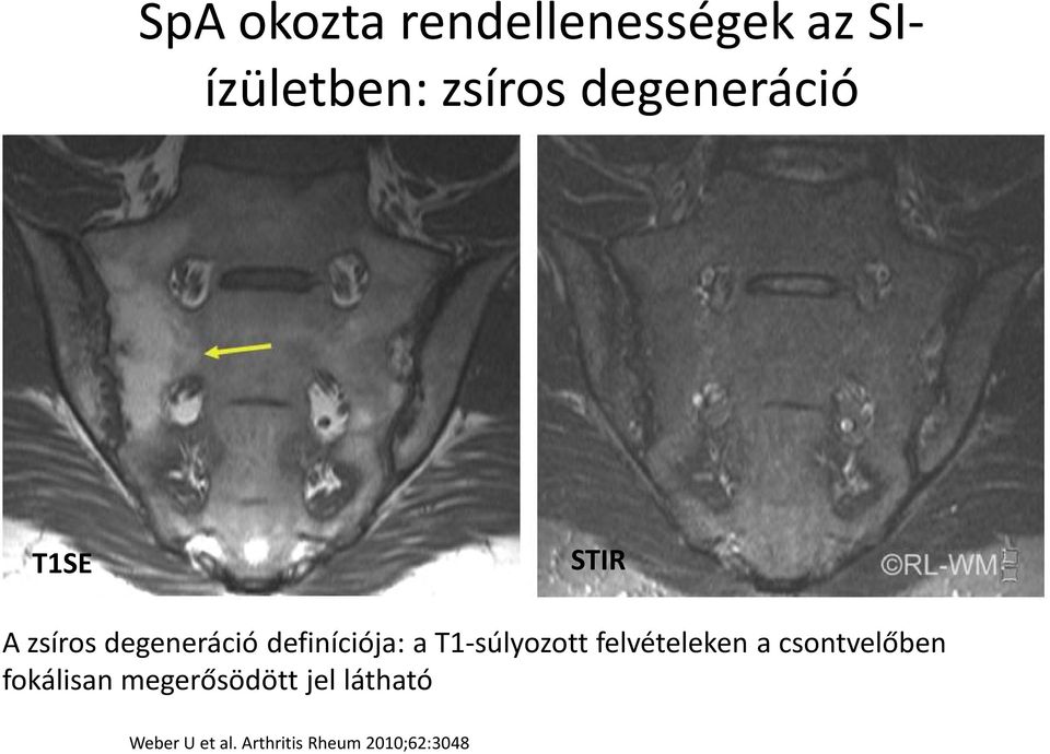 a T1-súlyozott felvételeken a csontvelőben fokálisan