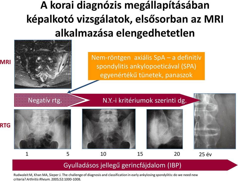 -i kritériumok szerinti dg. RTG 1 5 10 15 20 25 év Gyulladásos jellegű gerincfájdalom (IBP) Rudwaleit M, Khan MA, Sieper J.
