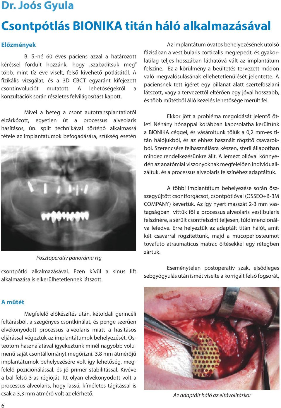 A fizikális vizsgálat, és a 3D CBCT egyaránt kifejezett csontinvoluciót mutatott. A lehetőségekről a konzultációk során részletes felvilágosítást kapott.