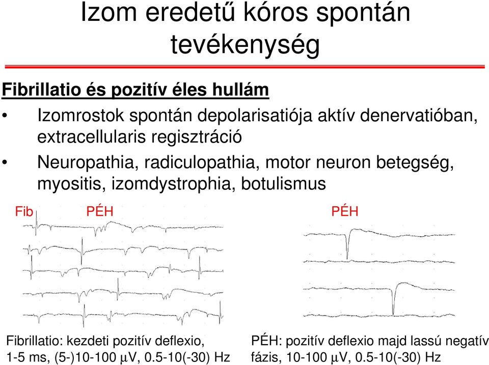 neuron betegség, myositis, izomdystrophia, botulismus Fib PÉH PÉH Fibrillatio: kezdeti pozitív