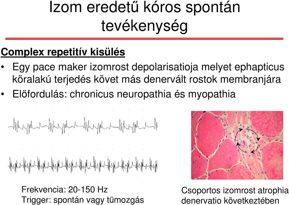 rostok membranjára Előfordulás: chronicus neuropathia és myopathia Frekvencia: