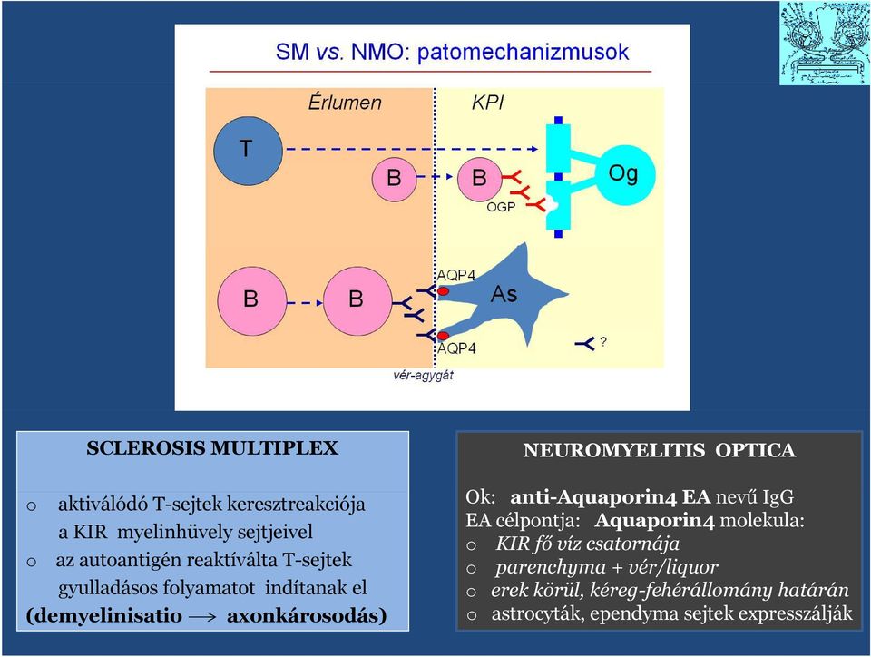 NEUROMYELITIS OPTICA Ok: anti-aquaprin4 i EA nevű ű IgG EA célpntja: Aquaprin4 mlekula: KIR fő víz