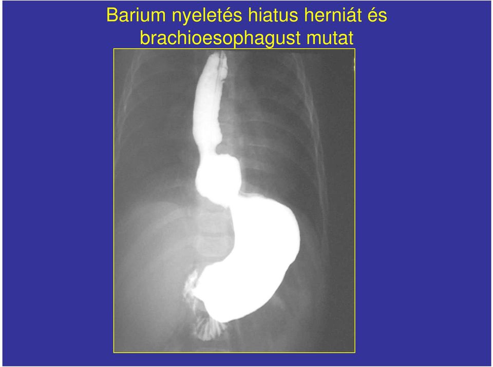 hiatus herniát