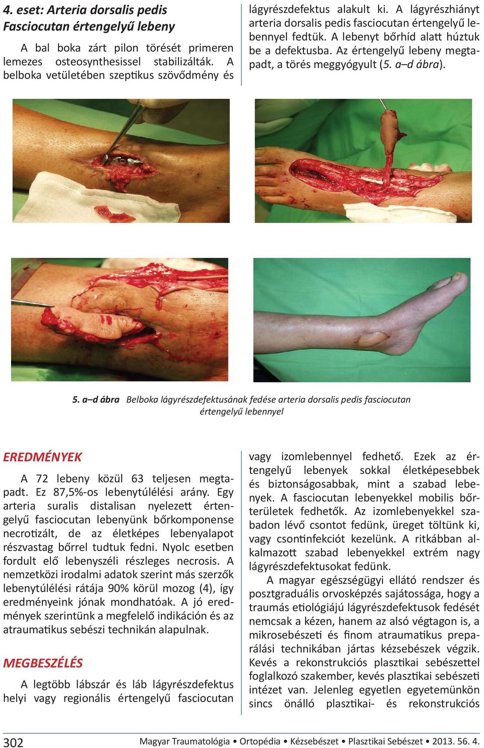 A lebenyt bőrhíd alatt húztuk be a defektusba. Az értengelyű lebeny megtapadt, a törés meggyógyult (5. a d ábra). 5.
