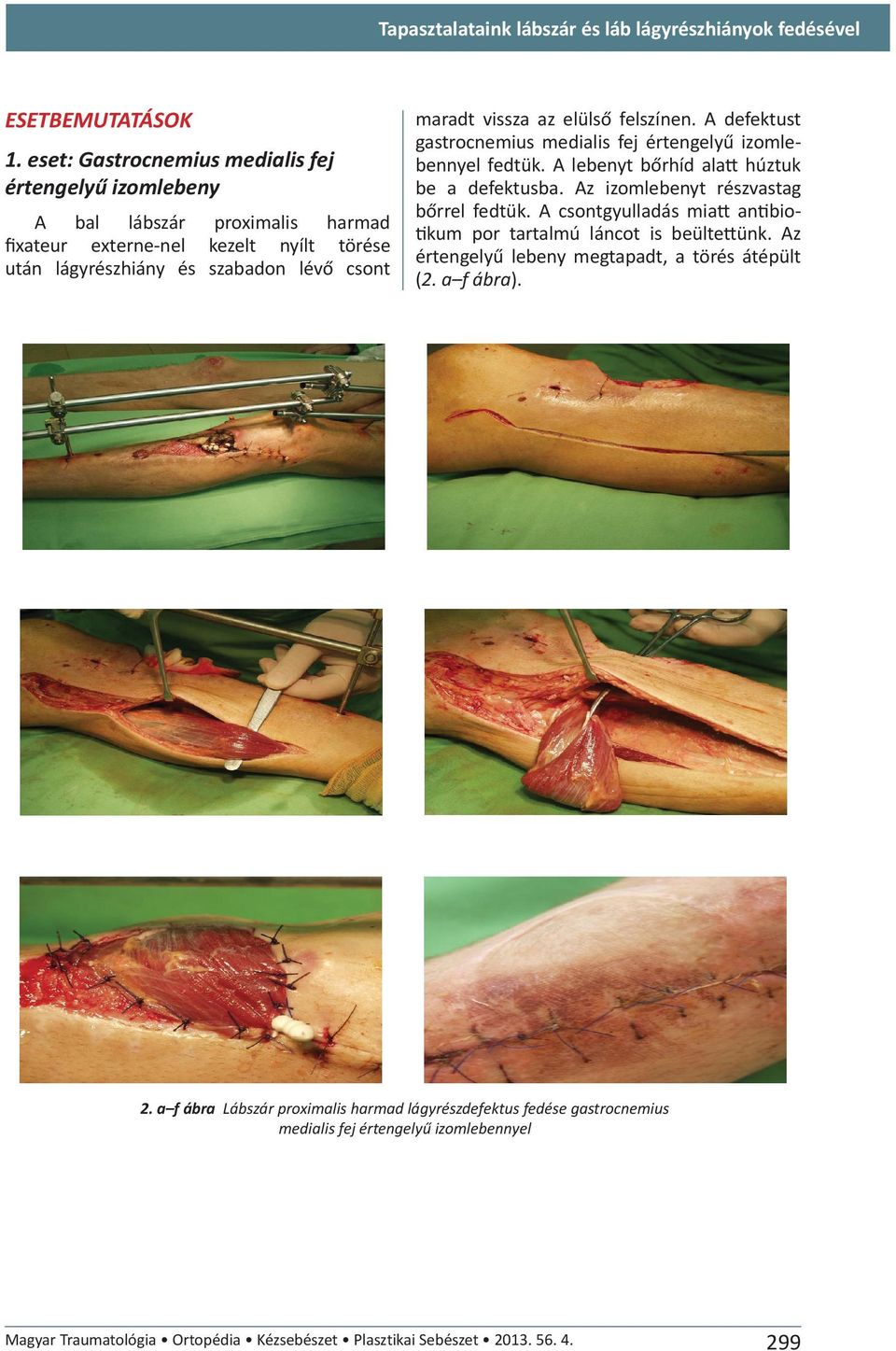 elülső felszínen. A defektust gastrocnemius medialis fej értengelyű izomlebennyel fedtük. A lebenyt bőrhíd alatt húztuk be a defektusba. Az izomlebenyt részvastag bőrrel fedtük.