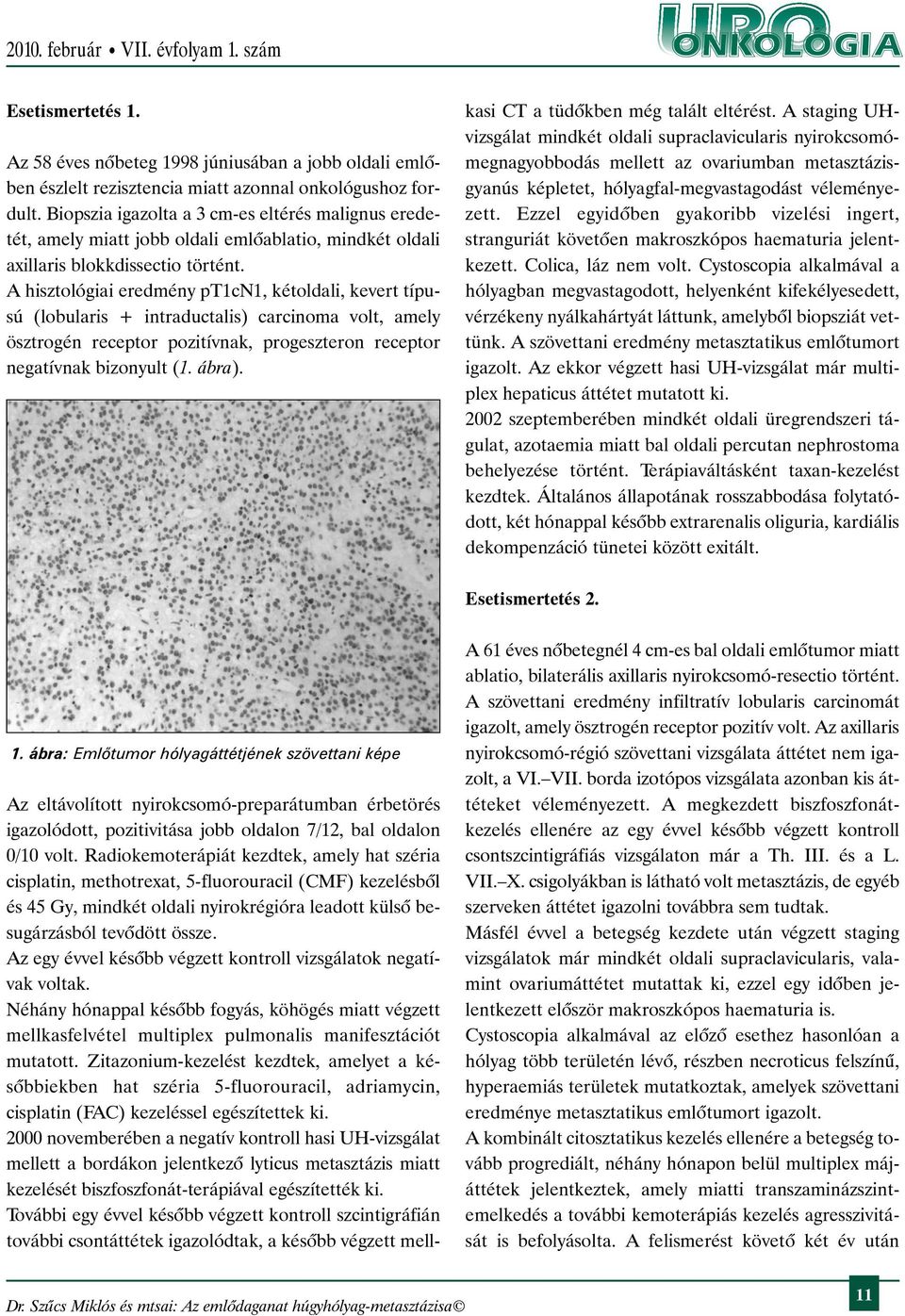 A hisztológiai eredmény ptcn, kétoldali, kevert típusú (lobularis + intraductalis) carcinoma volt, amely ösztrogén receptor pozitívnak, progeszteron receptor negatívnak bizonyult (. ábra).