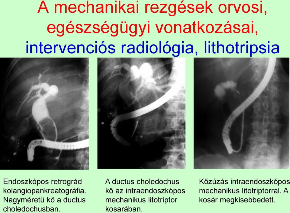 Nagyméretű kő a ductus choledochusban.