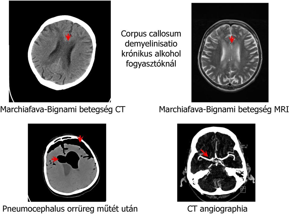betegség CT Marchiafava-Bignami betegség