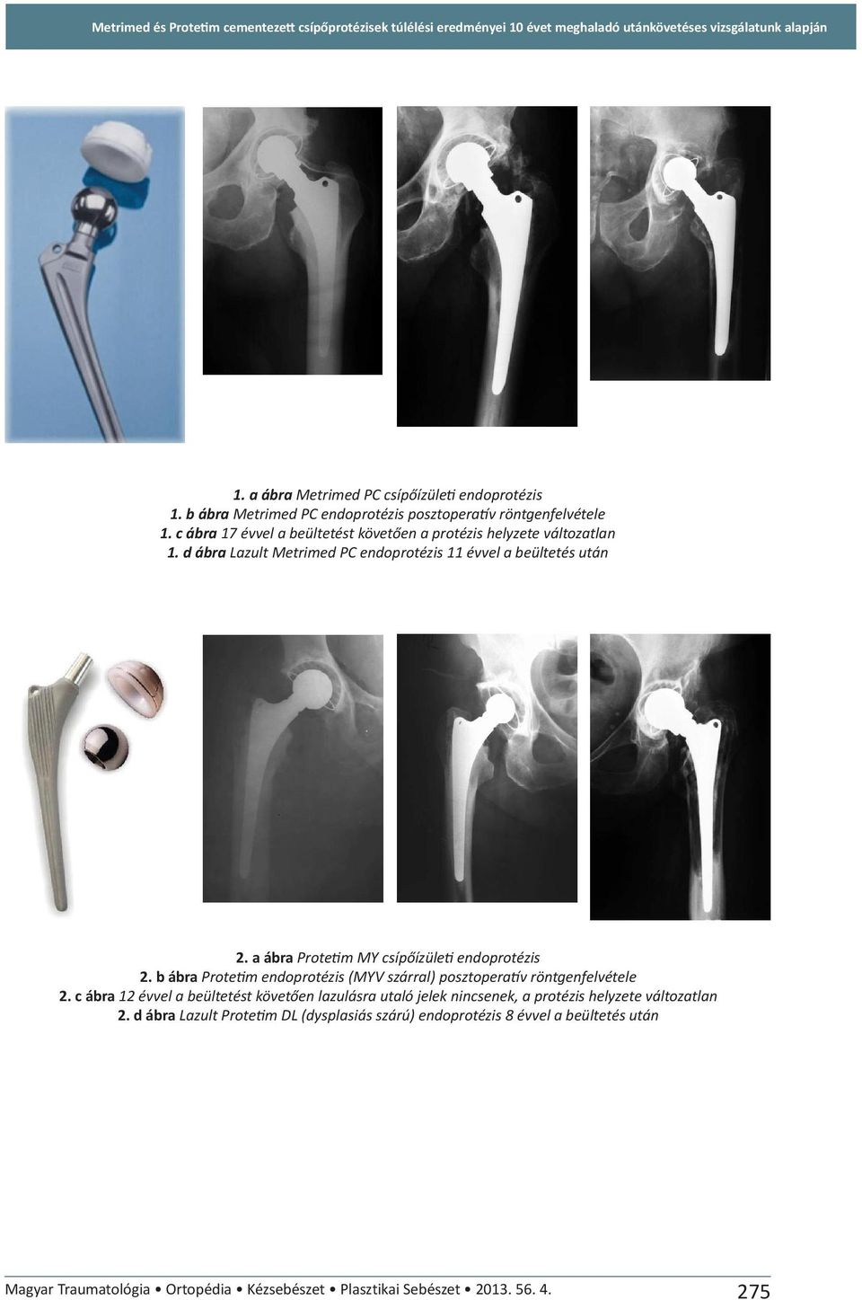 d ábra Lazult Metrimed PC endoprotézis 11 évvel a beültetés után 2. a ábra Protetim MY csípőízületi endoprotézis 2. b ábra Protetim endoprotézis (MYV szárral) posztoperatív röntgenfelvétele 2.