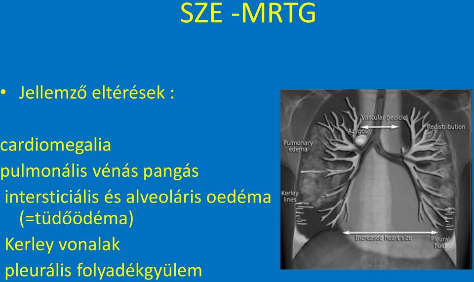 intersticiális és alveoláris oedéma