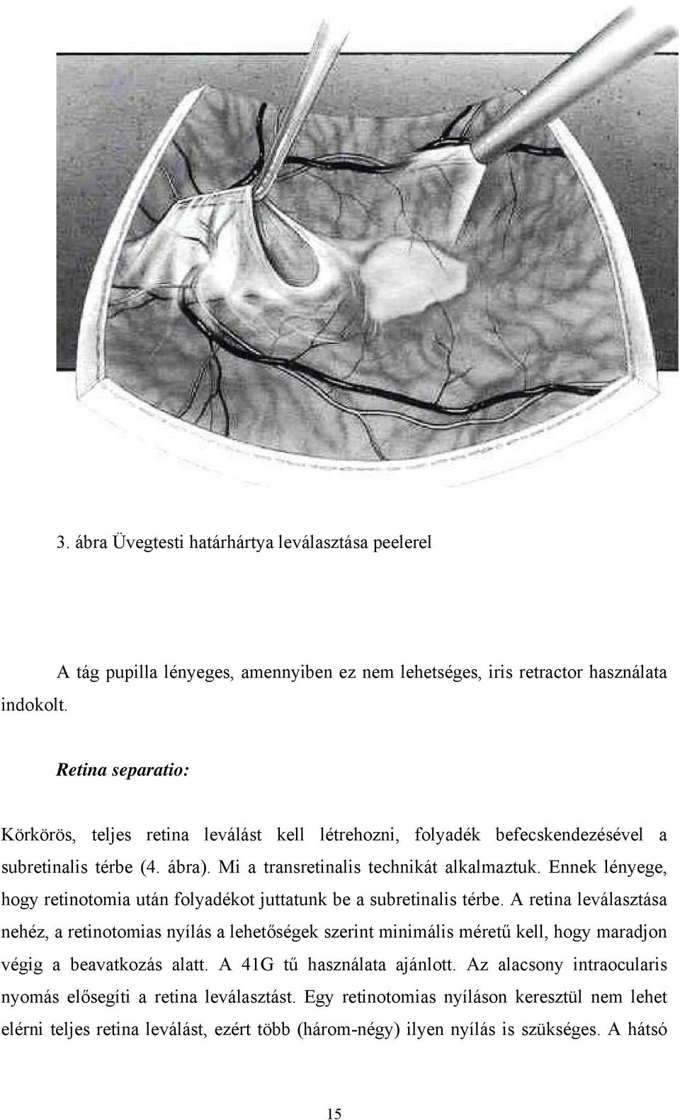 Ennek lényege, hogy retinotomia után folyadékot juttatunk be a subretinalis térbe.