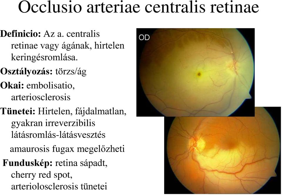 Osztályozás: törzs/ág Okai: embolisatio, arteriosclerosis Tünetei: Hirtelen,