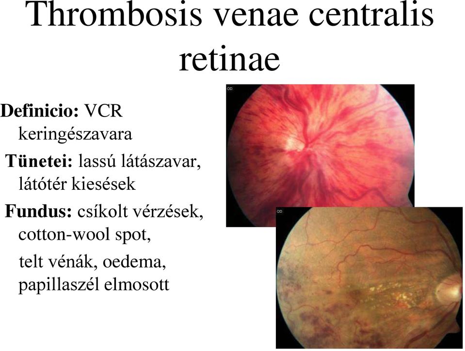 látótér kiesések Fundus: csíkolt vérzések,