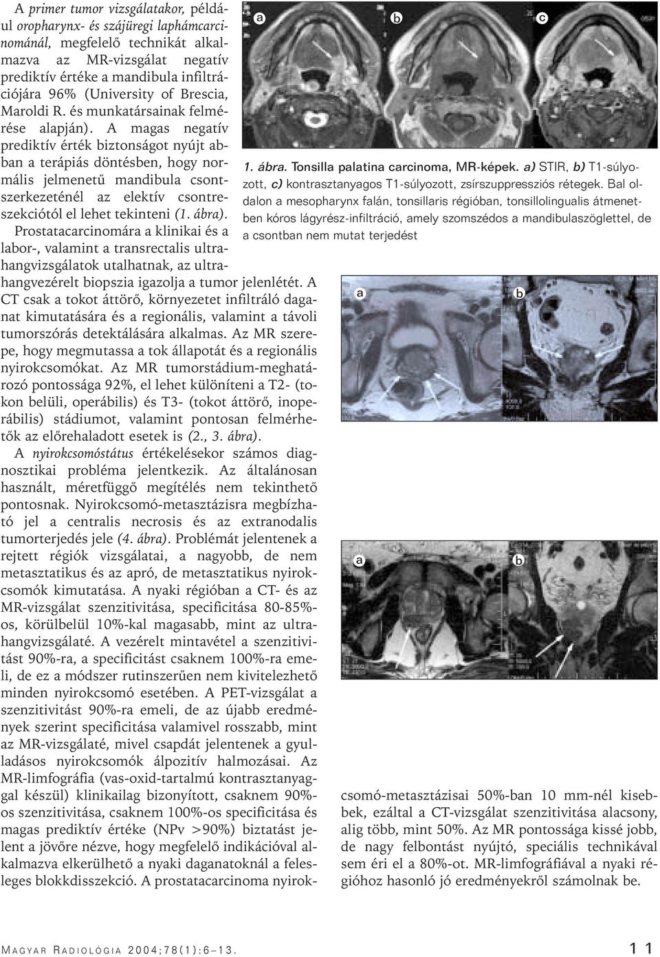 primer tumor vizsgálatakor, például oropharynx- és szájüregi laphámcarcinománál, megfelelô technikát alkalmazva az MR-vizsgálat negatív prediktív értéke a mandibula infiltrációjára 96% (University of