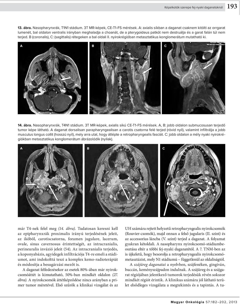 (coronalis), : (sagittalis) rétegeken a bal oldali II. nyirokrégióban metasztatikus konglomerátum mutatható ki. 14. ábra. Nasopharynxrák, T4N1 stádium. 3T MR-képek, axialis síkú E-T1-FS mérések.