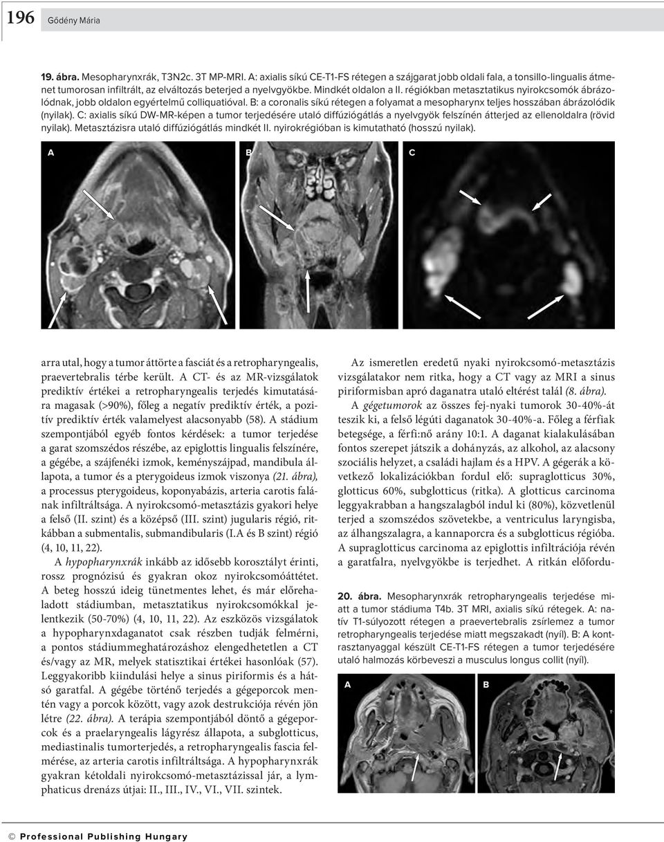 : a coronalis síkú rétegen a folyamat a mesopharynx teljes hosszában ábrázolódik (nyilak).