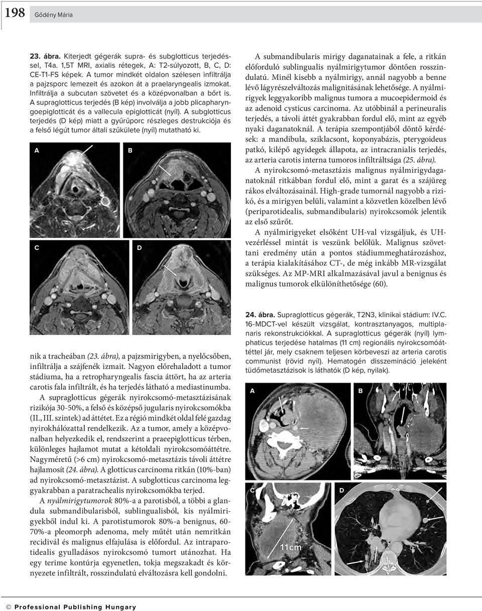 supraglotticus terjedés ( kép) involválja a jobb plica pha ryngoepiglotticát és a vallecula epiglotticát (nyíl).