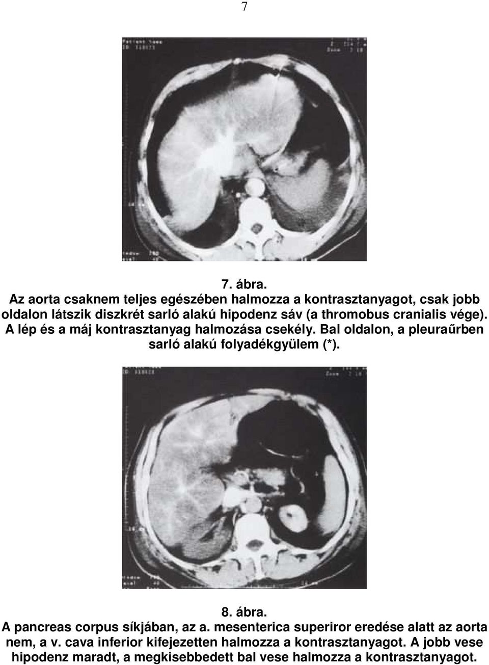 thromobus cranialis vége). A lép és a máj kontrasztanyag halmozása csekély.