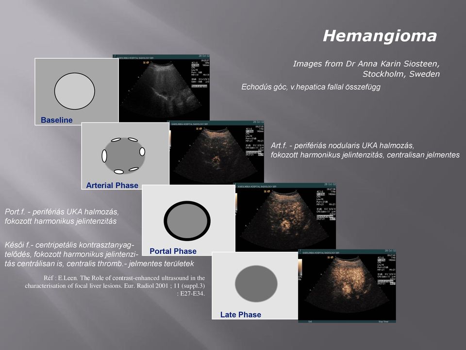 - centripetális kontrasztanyagtelődés, fokozott harmonikus jelintenzitás centrálisan is, centralis thromb.- jelmentes Portal Phase területek Réf : E.