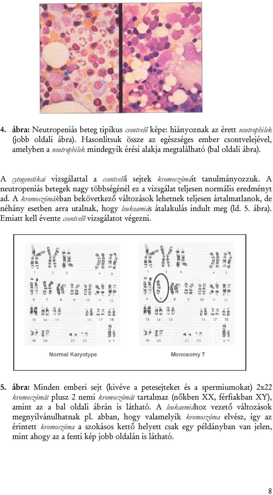 A cytogenetikai vizsgálattal a csontvelői sejtek kromoszómáit tanulmányozzuk. A neutropeniás betegek nagy többségénél ez a vizsgálat teljesen normális eredményt ad.