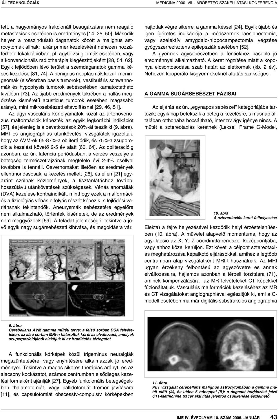 agytörzsi gliomák esetében, vagy a konvencionális radiotherápia kiegészítôjeként [28, 54, 62]. Egyik fejlôdôben lévô terület a szemdaganatok gamma késes kezelése [31, 74].