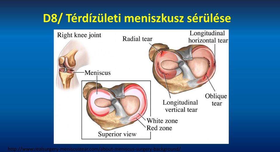 realsurgery-meniscustear.