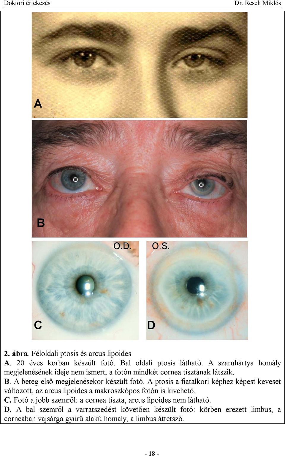 A ptosis a fiatalkori képhez képest keveset változott, az arcus lipoides a makroszkópos fotón is kivehető. C.