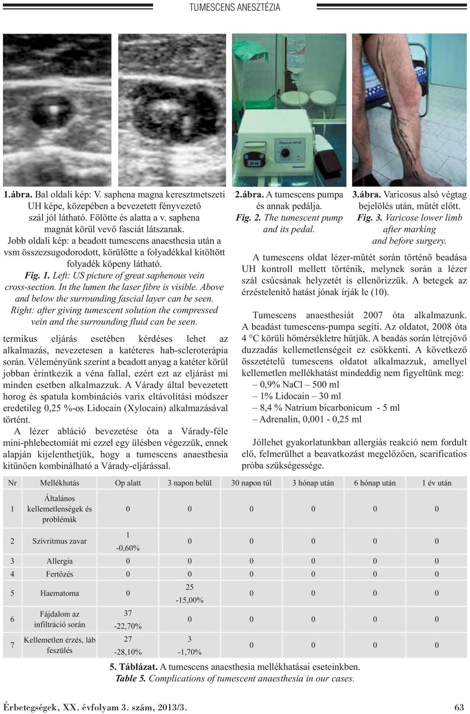 Left: US picture of great saphenous vein cross-section. In the lumen the laser fibre is visible. Above and below the surrounding fascial layer can be seen.