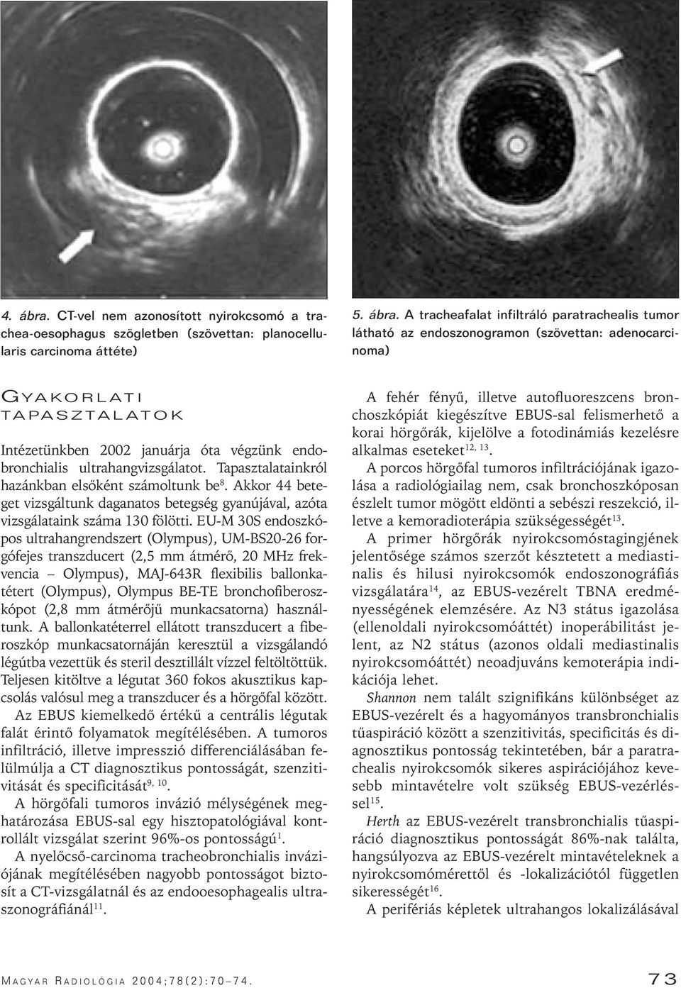 A tracheafalat infiltráló paratrachealis tumor látható az endoszonogramon (szövettan: adenocarcinoma) GYAKORLATI TAPASZTALATOK Intézetünken 2002 januárja óta végzünk endoronchialis