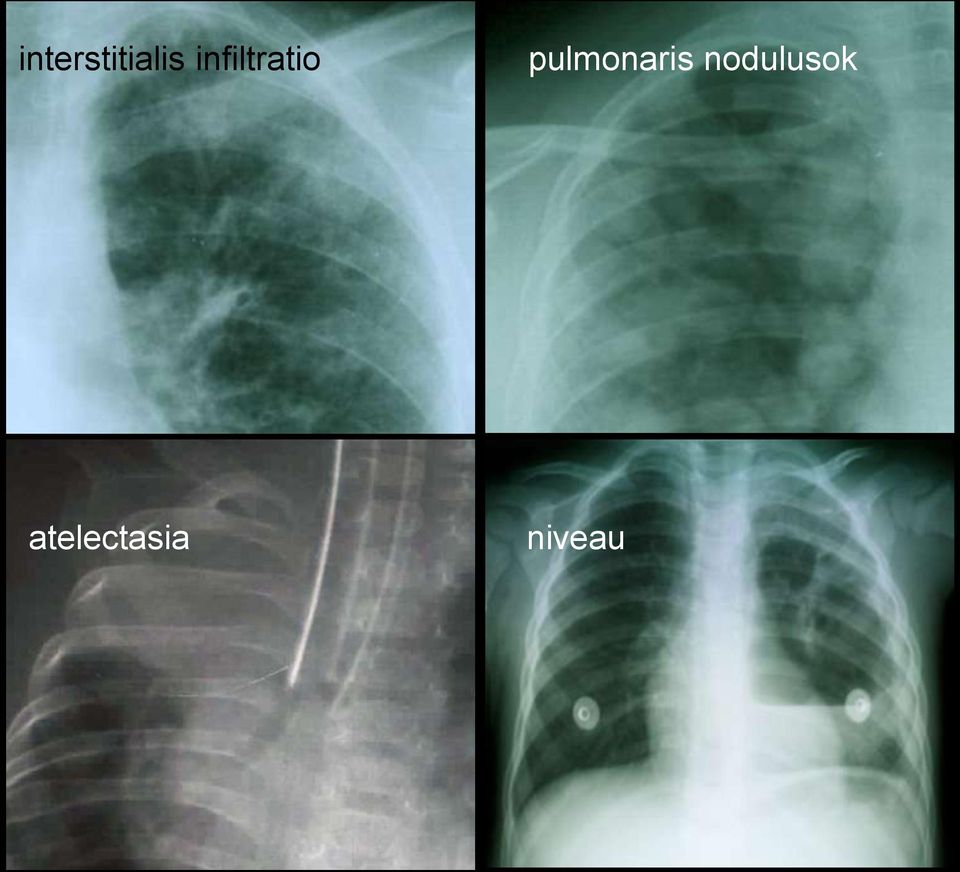 pulmonaris