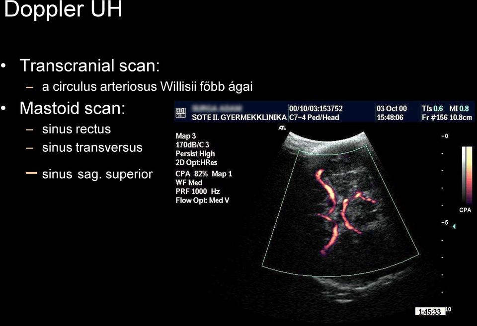 ágai Mastoid scan: sinus rectus