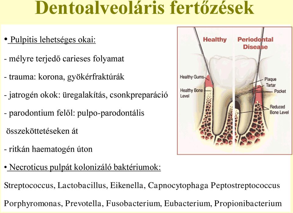 összeköttetéseken át - ritkán haematogén úton Necroticus pulpát kolonizáló baktériumok: Streptococcus,