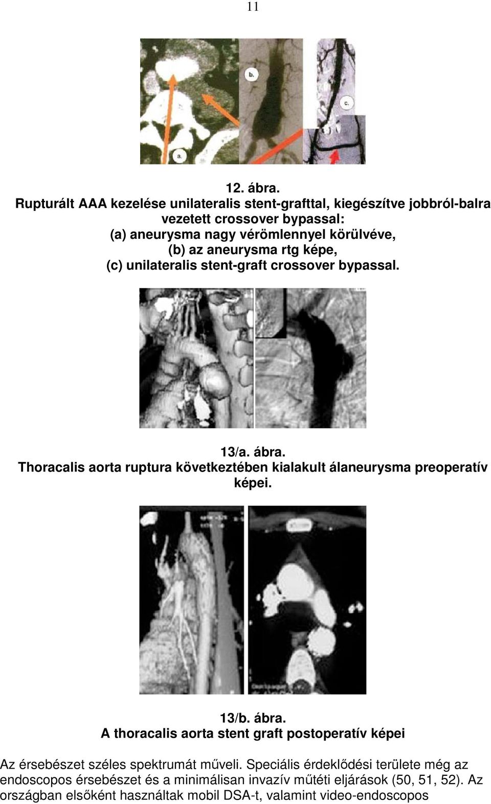 az aneurysma rtg képe, (c) unilateralis stent-graft crossover bypassal. 13/a. ábra.