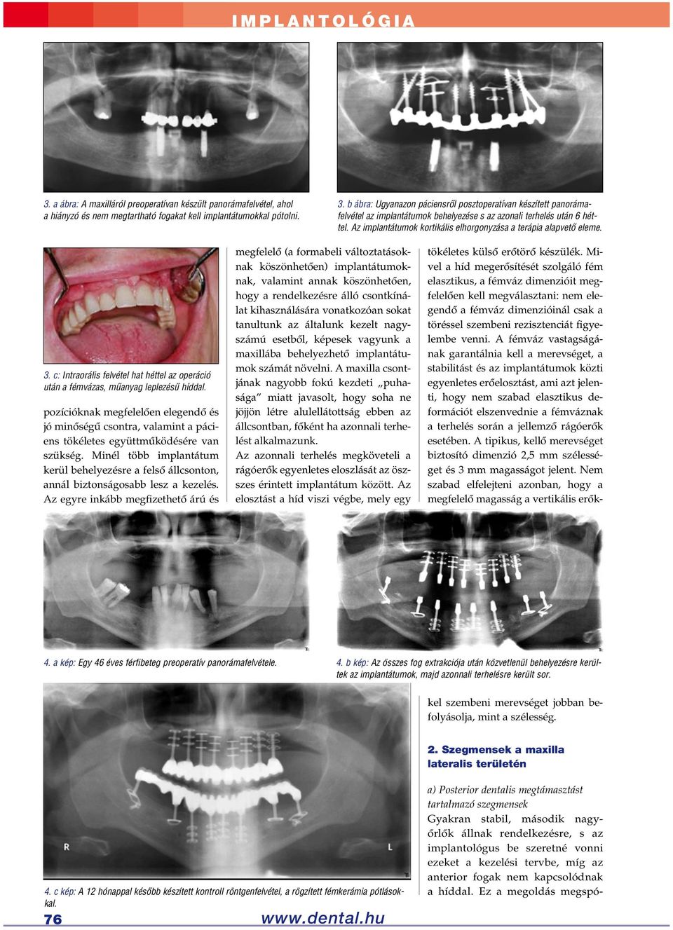 Az implantátumok kortikális elhorgonyzása a terápia alapvető eleme. 3. c: Intraorális felvétel hat héttel az operáció után a fémvázas, műanyag leplezésű híddal.