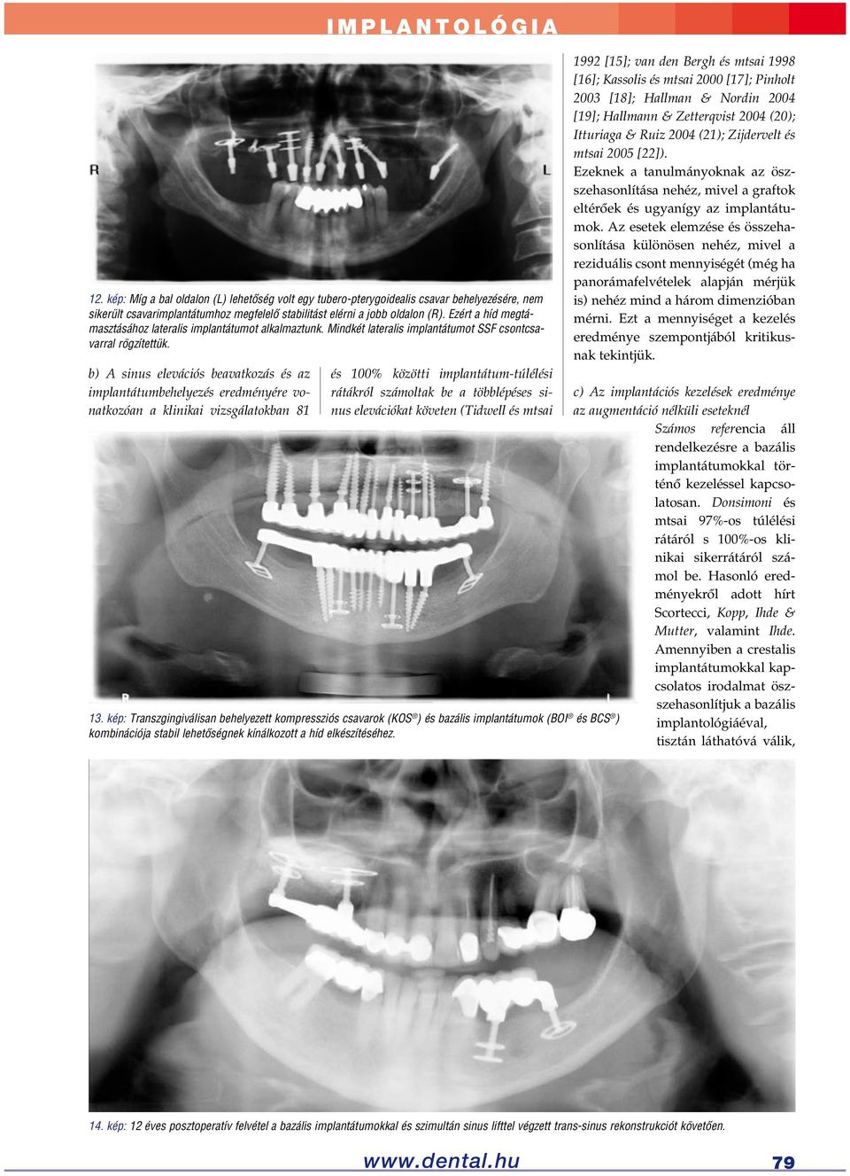 b) A sinus elevációs beavatkozás és az implantátumbehelyezés eredményére vonatkozóan a klinikai vizsgálatokban 81 és 100% közötti implantátum-túlélési rátákról számoltak be a többlépéses sinus