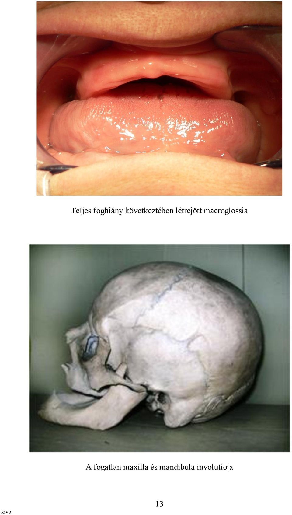 macroglossia A fogatlan