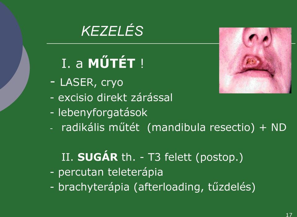 lebenyforgatások - radikális műtét (mandibula resectio)