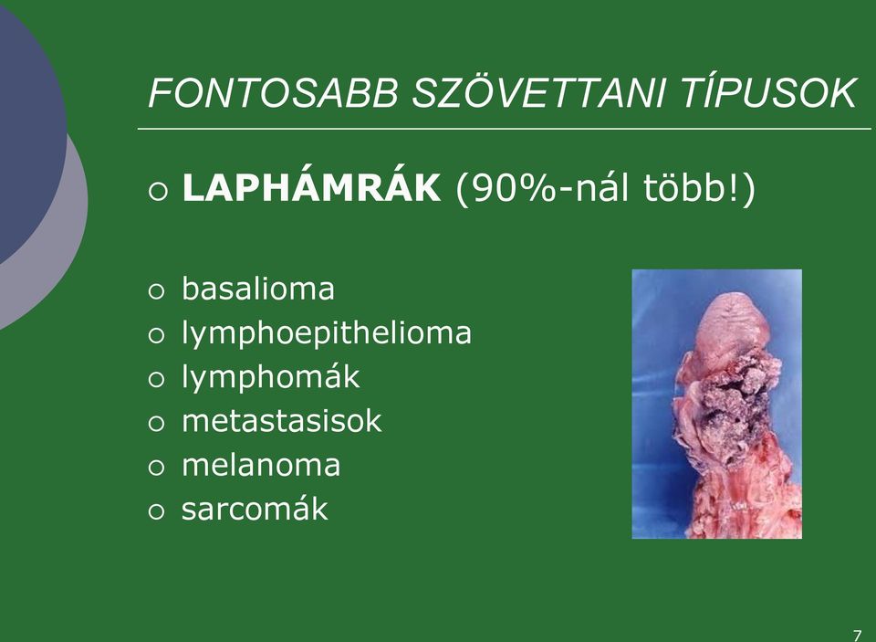 ) basalioma lymphoepithelioma
